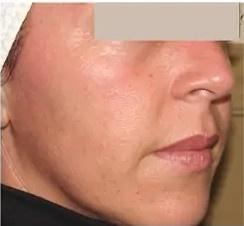 Benefits of Laser Treatments for Pigmentation